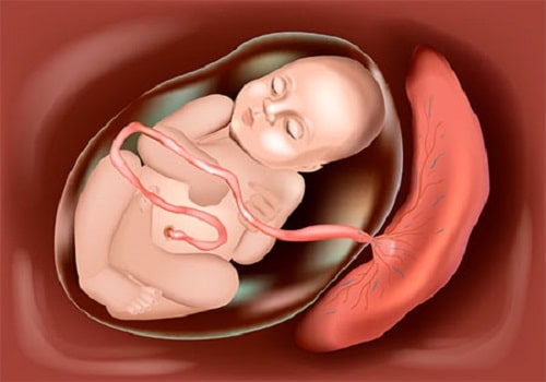 hematoma-en-el-utero